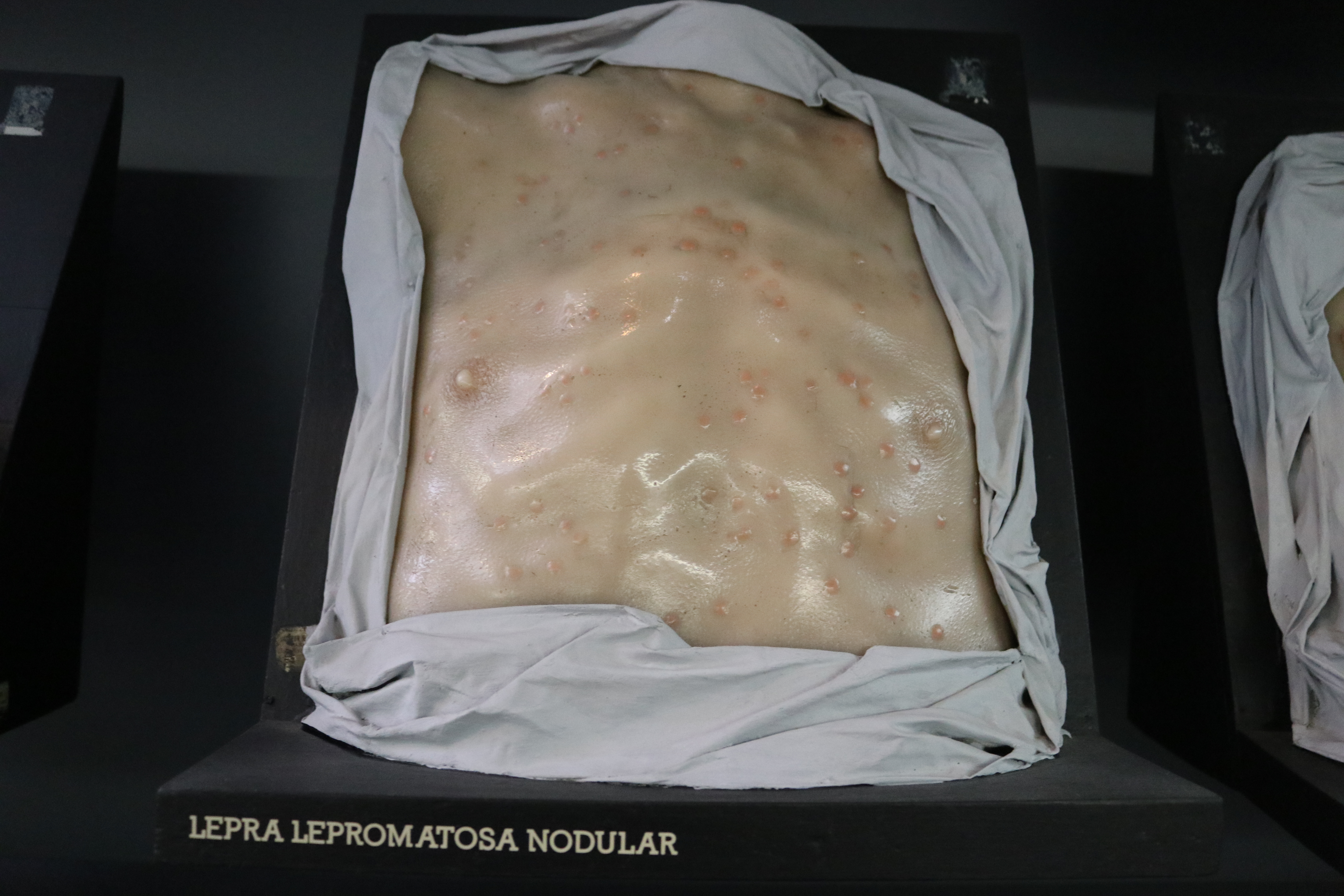 Una enfermedad milenaria en extinción