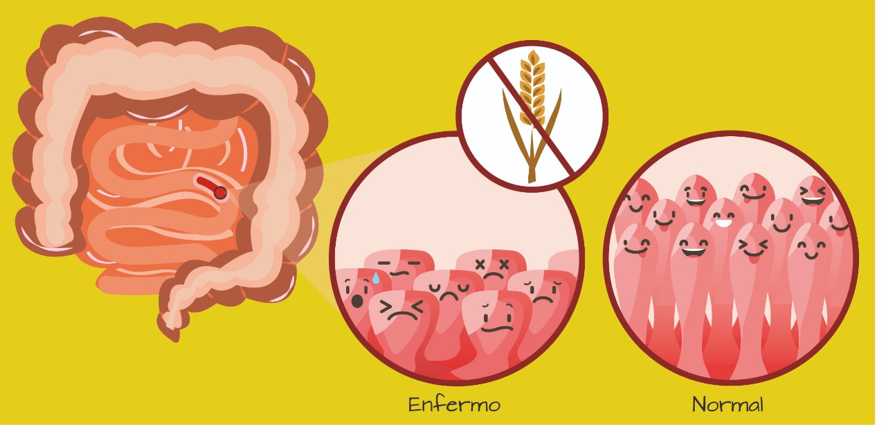 Intolerancia al gluten es poco frecuente en México